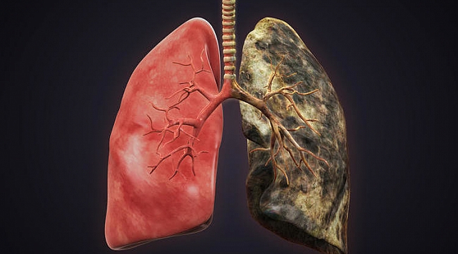 Akciğer kanserinde önemli gelişme