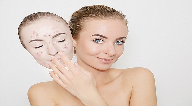 Akne ilacını, dermatoloji uzmanı gözetiminde güvenle kullanabilirsiniz