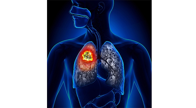 Akciğer kanserinden korunmanın 6 yolu (En önemli risk faktörü sigara!)