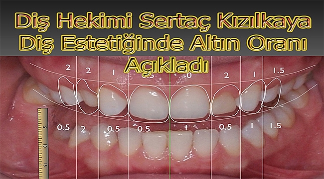 Diş Estetiğinde Altın Oran Dikkate Alınıyor