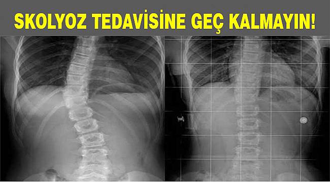 Skolyoz Hastalarına Bunlara Dikkat Etmeli