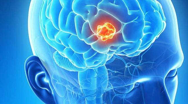 Beyin tümöründe en sık görülen 7 belirti 