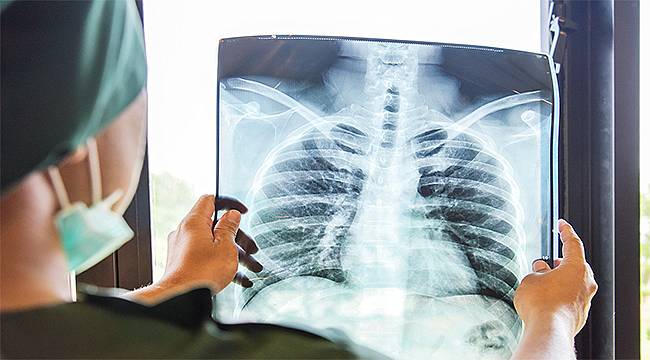 Gizli akciğer kanseri vakaları koronavirüs nedeniyle çekilen tomografilerde ortaya çıkıyor 