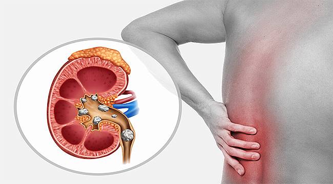 Böbrek Taşı Neden Olur? Belirtileri ve Tedavi Yöntemleri 