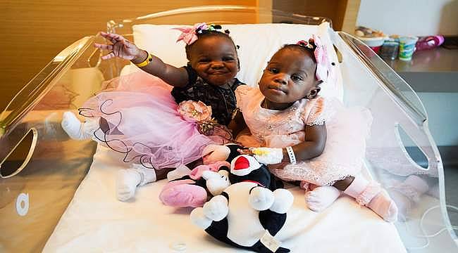 En güzel ayrılık: Yapışık ikizler Türkiye'de yeniden doğdu