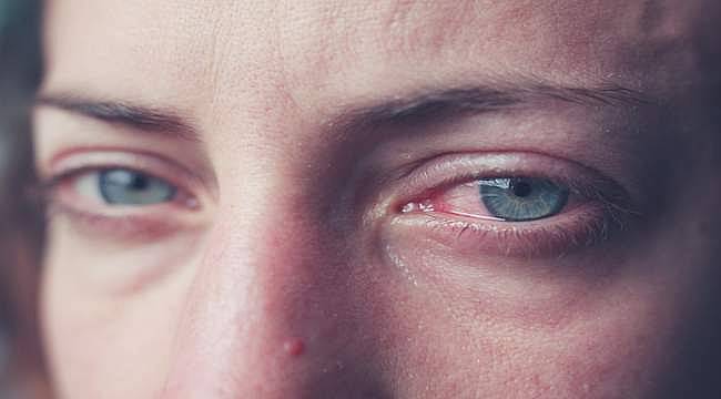 Göz nezlesi neden olur? Nasıl geçer? Belirtileri ve tedavisi 