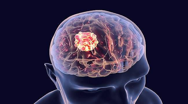 Beyin tümörünün ihmale gelmez 10 önemli belirtisi... 