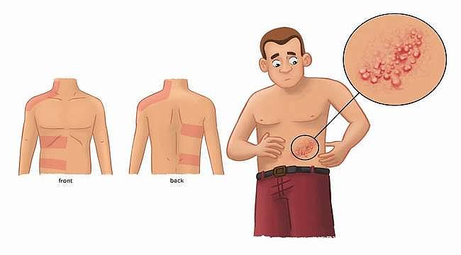 Zona hastalığı nedir? Zona hastalığı belirtileri ve tedavisi nelerdir?
